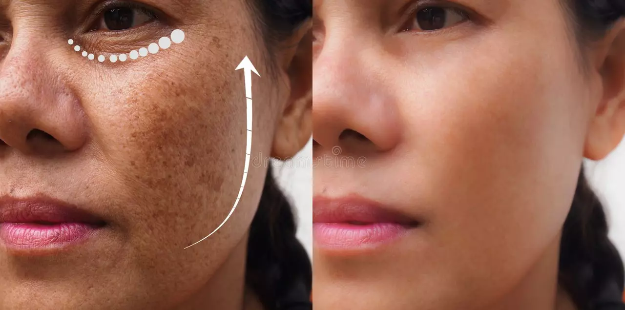 The Emotional Impact of Melasma: Coping with Skin Discoloration