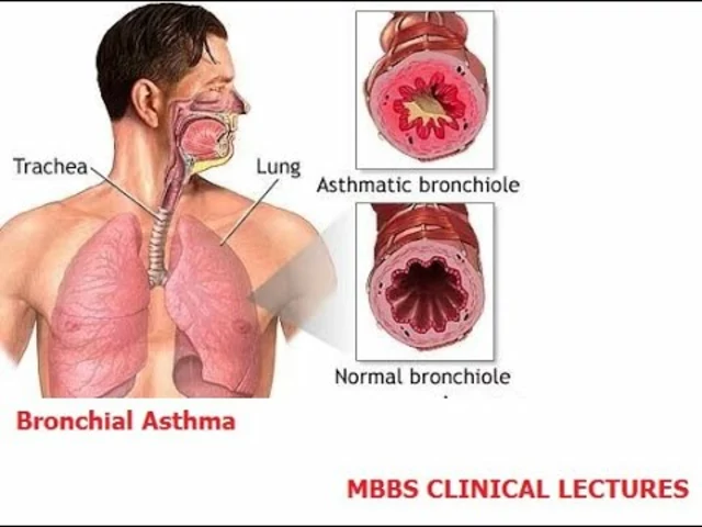 The Role of Environmental Factors in Bronchial Asthma