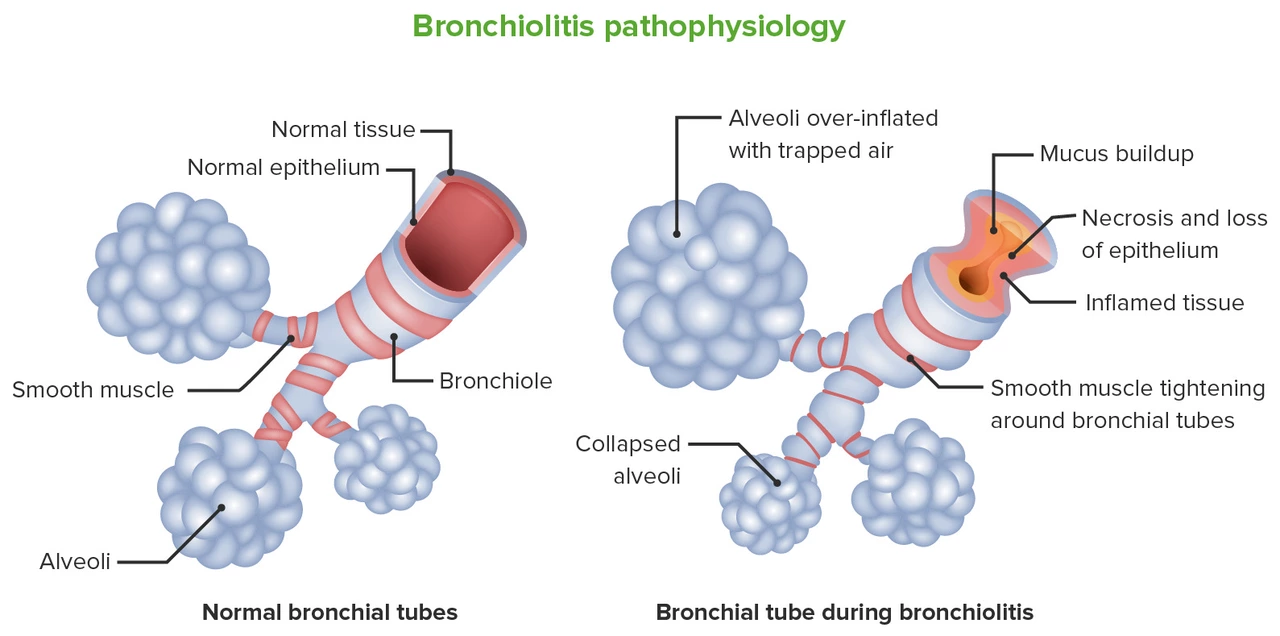 The Role of Terbutaline in the Treatment of Bronchiolitis
